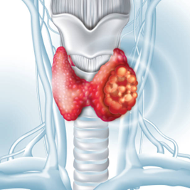 thyroid cancer