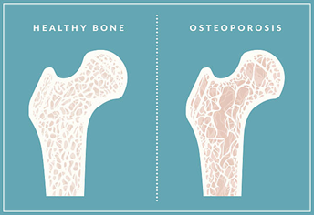 osteoporosis