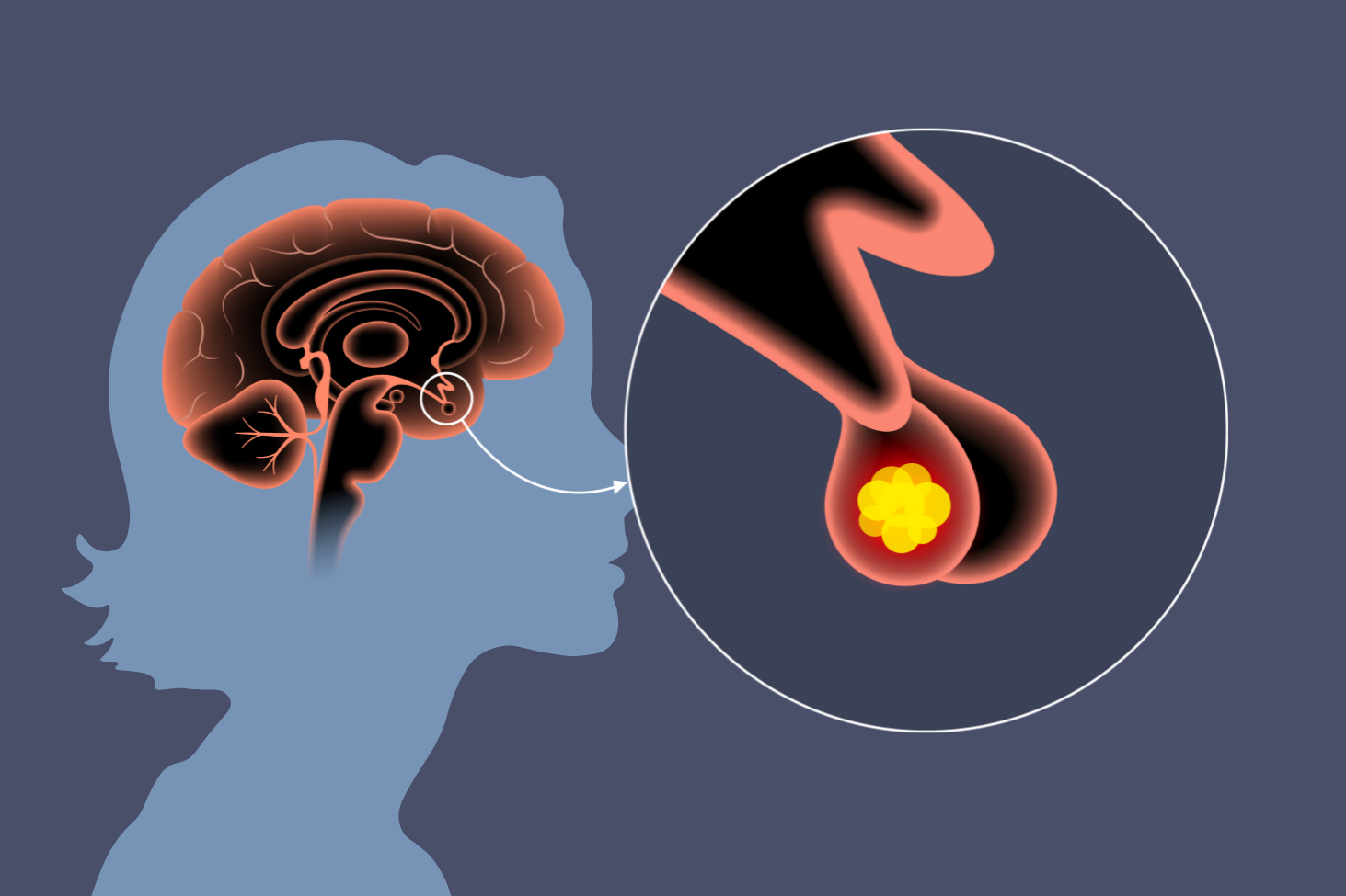 What Is a Pituitary Tumor?