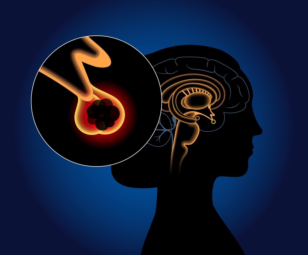 Pituitary Tumors Treatment