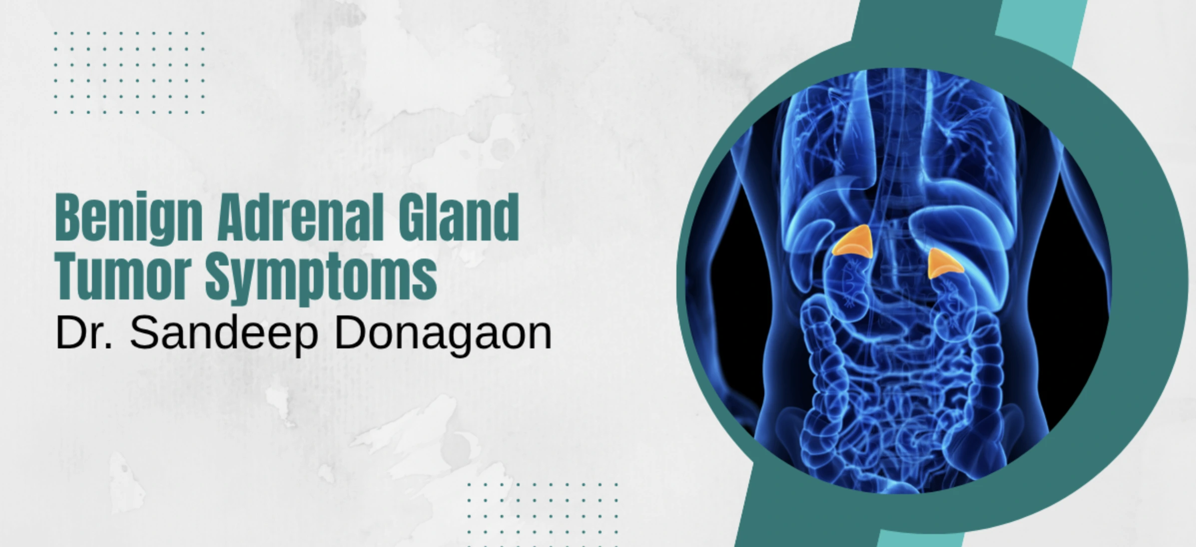 Benign Adrenal Gland Tumor Symptoms: What You Need to Know