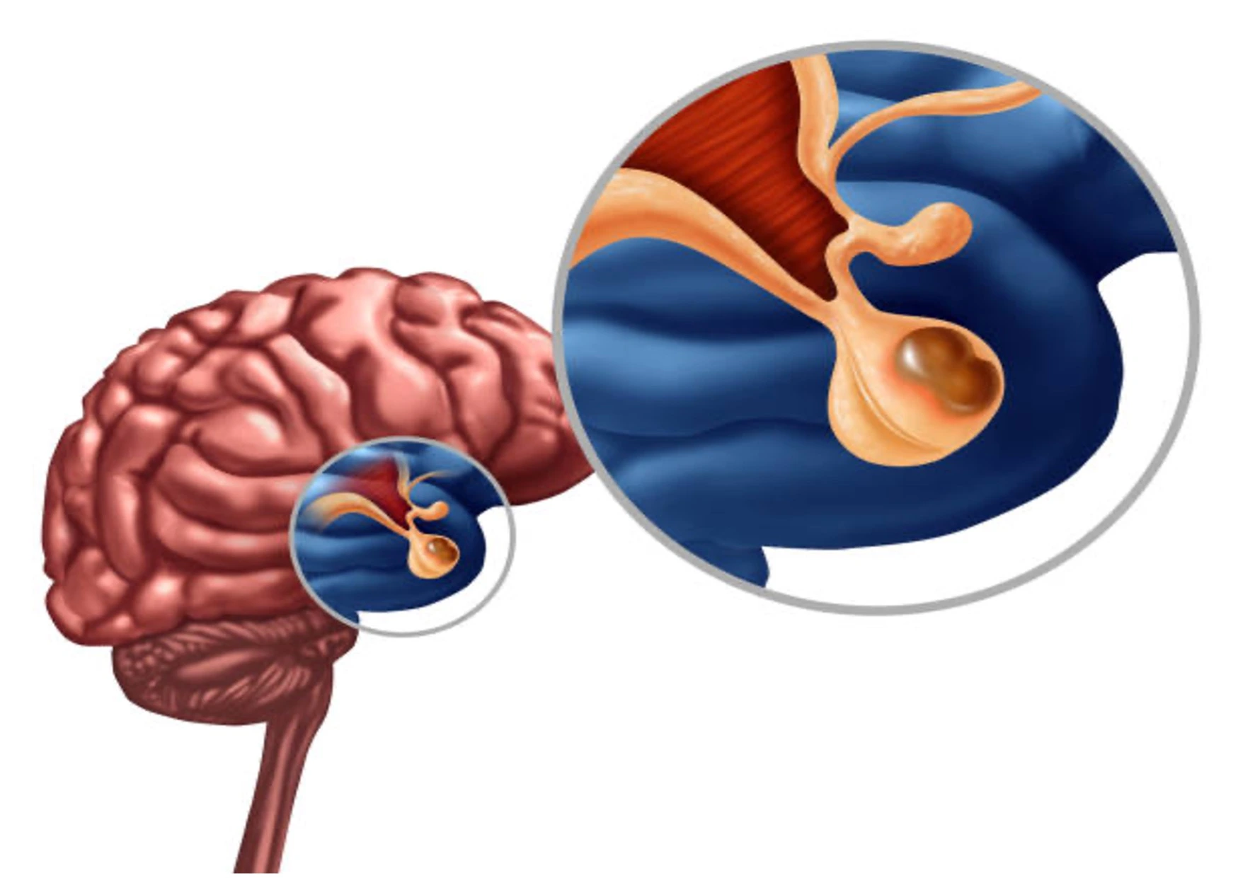 Adenoma Picture 1 Side view of a human brain with a circular magnified inset showing the inner ear anatomy (cochlea and semicircular canals)
