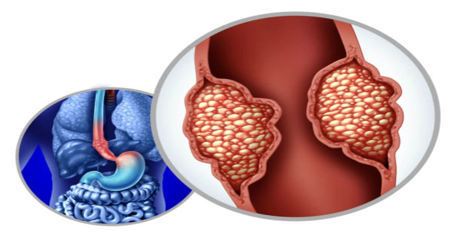 Adenoma Picture 2 Two overlapping diagrams: an artery with cholesterol plaque buildup and a separate illustration of the digestive system (stomach and intestines).
