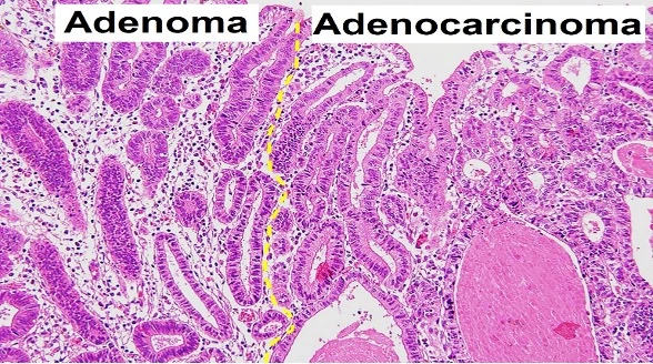 Adenoma Picture 3 Histology slide showing adenoma on the left and adenocarcinoma on the right, with a yellow dashed line marking the transition between benign and malignant tissue.